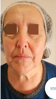 Antes tratamiento corporal