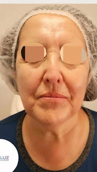 Después tratamiento corporal